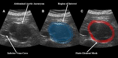 Intermediate pressure-normalized principal wall strain values are associated with increased abdominal aortic aneurysmal growth rates